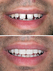 Cosmetic-Dentistry-Before-and-after