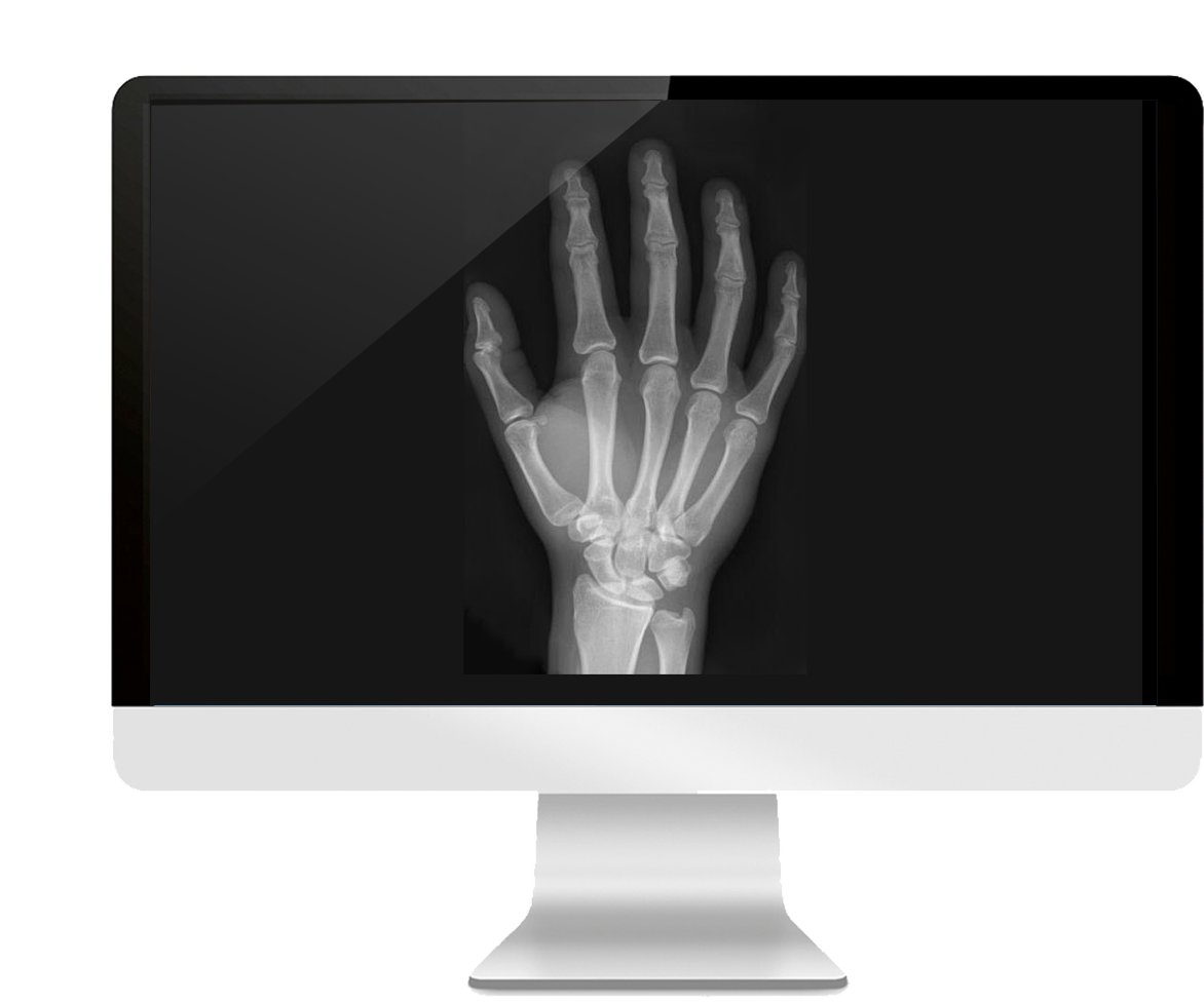 Carpal Index